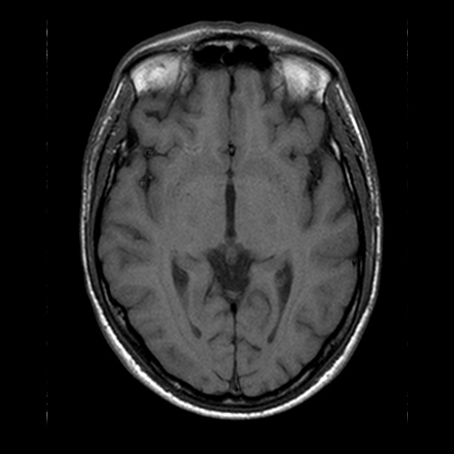 Aufnahme einer Magnetresonaztomographie vom Gehirn